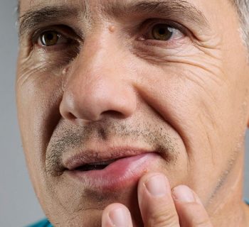 How to Prevent Mouth Sores and their Effective treatment