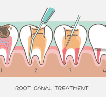 Signs You Might Need a Root Canal: When to Go to a Dentist